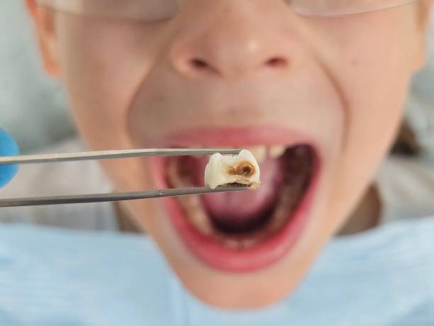 Best Emergency Treatment for Toothache in Kittanning, PA